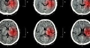 Dual therapy helps stroke patients recover use of limbs – clinical trial Stroke