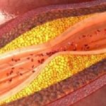 Coronary