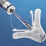 MitraClip