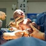 Baby being born via Caesarean Section coming out