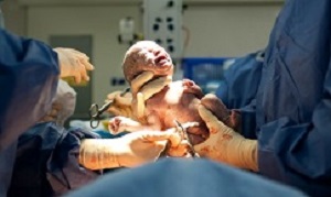 Baby being born via Caesarean Section coming out