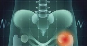 Following elective hip surgery, patients report new health problems Hipbones