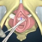 Vaginal