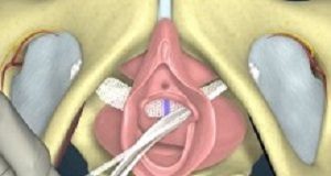 Many more mesh sling insertions should be reversed Vaginal
