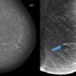 tomosynthesis