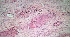 Cervical cancer survival rates determined by race in SA Cervix