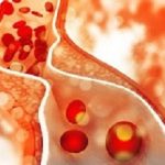 Cholesterol plaque in artery