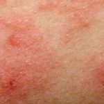 Eczema