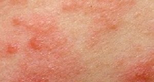 Allergy shots may help with severe atopic dermatitis Eczema