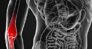 Meta-analysis of non-surgical treatments for tennis elbow 3d render medical illustration of the arm pain