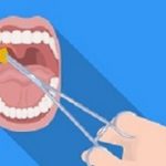 Tonsillectomy