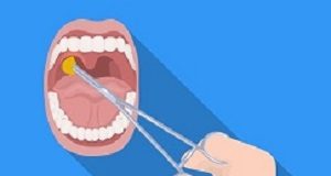 GPs overwhelmingly incorrect in deciding on tonsillectomies Tonsillectomy