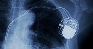 Implant investigation shows costs of poor regulation and testing x-ray image of permanent pacemaker implant in chest body , process in blue tone