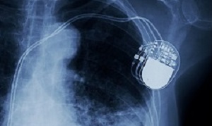 x-ray image of permanent pacemaker implant in chest body , process in blue tone