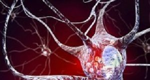 Small pioneering study offers hope to Parkinson's patients Parkinson