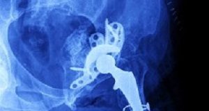 Survival data on hip and knee replacements from 6 countries over 25 years Prosthesis