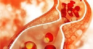 Large UK study finds statins fail to lower cholesterol in over half of patients Cholesterol