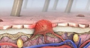 South Africa's black population also faces significant melanoma risk Melanoma