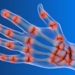 Arthritis