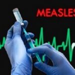 Measles
