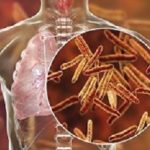 Tuberculosis