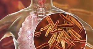 FDA approves treatment for highly drug-resistant forms of TB Tuberculosis