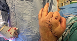 UK man's severed hand saved by temporarily sewing it into his groin Hand