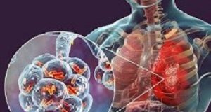 Updated guidelines on diagnosis treatment of community-acquired pneumonia Pneumonia