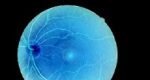 Interstitial cystitis medication may be toxic to the retina Retina