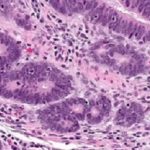 Immunotherapy