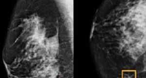 Google Health using AI to improve breast cancer screening Breast