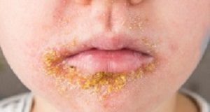 Second antibiotic no advantage for treating super-bug Golden Staph GoldenStaf