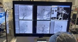 First successful robotic surgery for brain aneurysm VitorMendesPereira