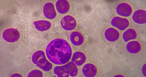 Microcytosis in men linked to more than double the risk of cancer Microcytosis