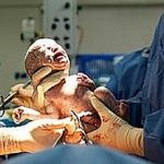 Baby being born via Caesarean Section