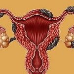Endometriosis