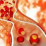 Cholesterol plaque in artery