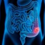 4-MB-Editors Picks-01-10-2020-Colorectal cancer-iStock-1256373514
