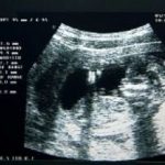 7-MB-Editors Picks-24-09-2020-Baby-Womb-Ultrasound-iStock-522623093