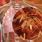 Secondary tuberculosis in lungs and close-up view of Mycobacterium tuberculosis bacteria