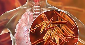 New TB regimen reduces treatment time by a third — clinical trial