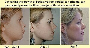 Derided theories of two British orthodontists now have a cult following