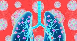 Donor to recipient transmission of SARS‐CoV‐2 by lung transplant