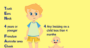 Clinical guide to diagnosing, in children, bruising caused by abuse