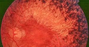 Optogenetics breakthrough restores partial sight in retinitis pigmentosa