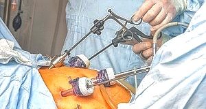 Bariatric surgery linked to decreased stroke risk – Canadian study