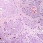 4-MB-Editors Picks-26-08-2021-Basal cell carcinoma-iStock-1049396964