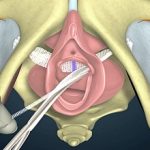 12-MB-Medico-Legal-02-09-2021-Vaginal mesh sling implant