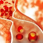 4-MB-Practitioners Must Read-09-09-2021-Cholesterol plaque-iStock-894954842