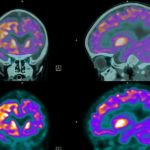 5-MB-Editors Picks-30-09-2021-Brain-Scan-PET-positron emission tomography-iStock-480338933